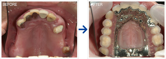 義歯（金属床）治療例